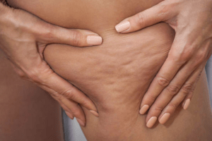Cómo reducir la celulitis con 4 alimentos (dentro de un plan realista)
