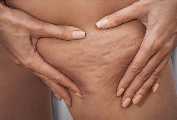 reducir la celulitis
