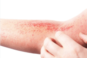 Aliviar y tratar la dermatitis atópica: cuidados diarios que marcan la diferencia