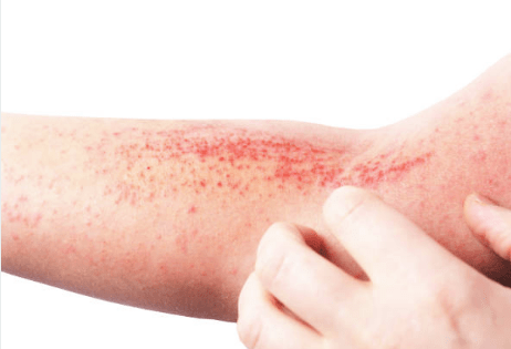 Dermatitis atópica