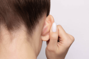 Síntomas de la dermatitis seborreica: cómo reconocerla y cuándo preocuparse
