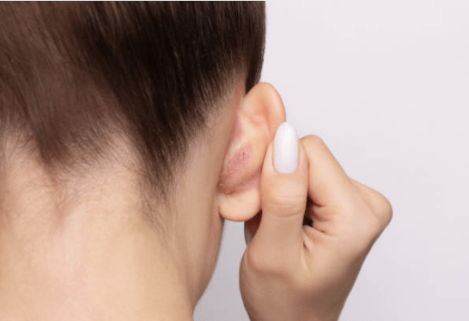 síntomas de la dermatitis seborreica